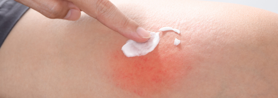 rubbing cream on skin rash