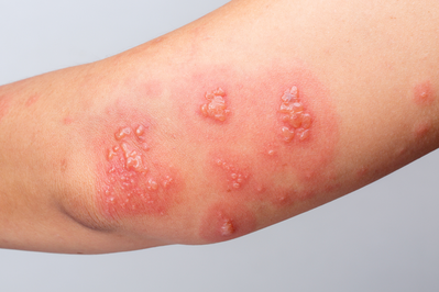 shingles rash on arm