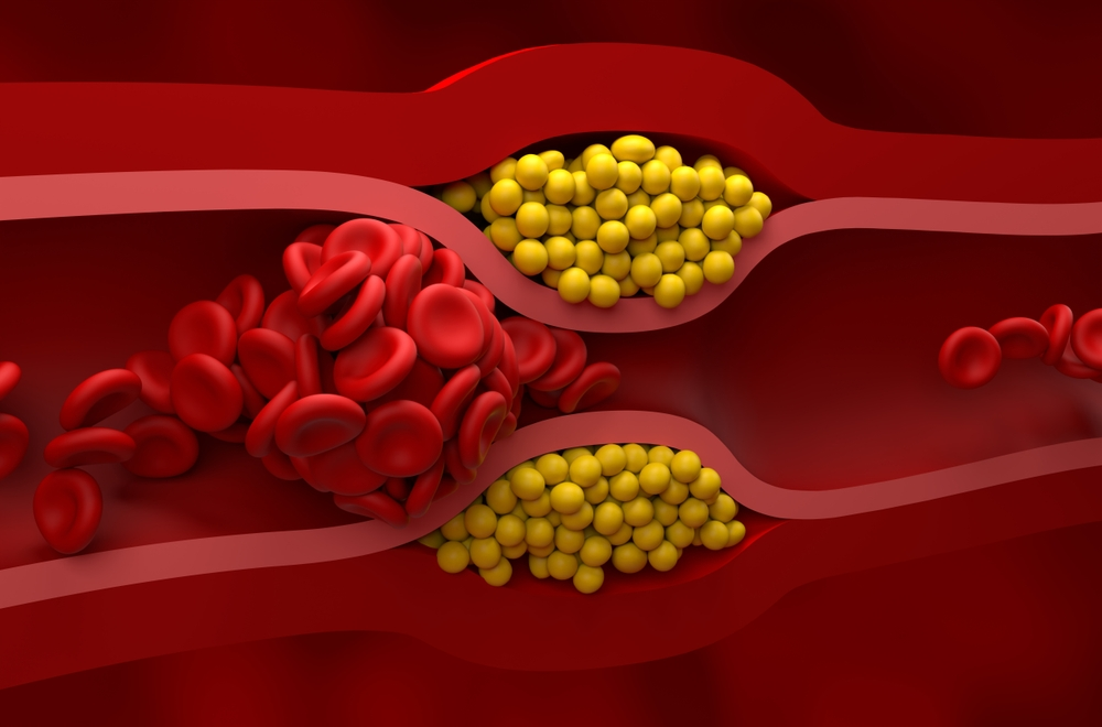 illustration showing buildup of plaque in artery blocking bloodflow